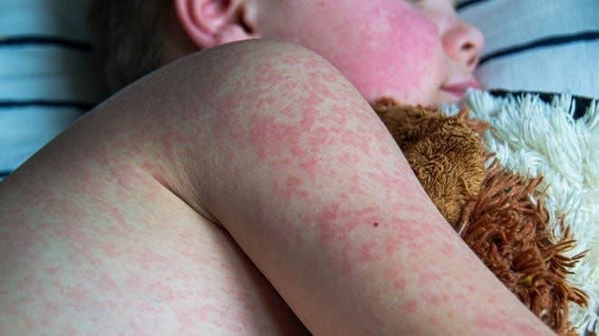 Measles